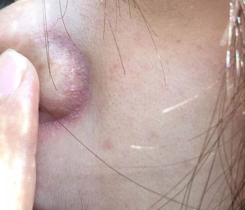 鼻翼两侧小沟沟泛红还有白皮,鼻翼两侧沟沟明显怎么办