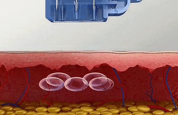 水光针能去除眼部细纹吗,菲洛嘉水光针可以去除细纹吗