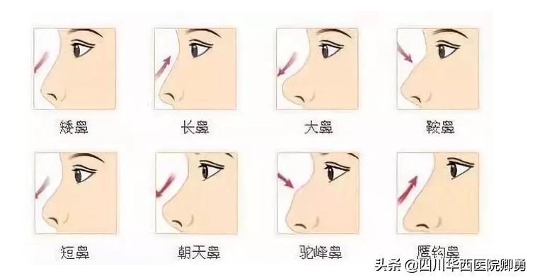 鼻部整形所有的项目,鼻部息肉手术