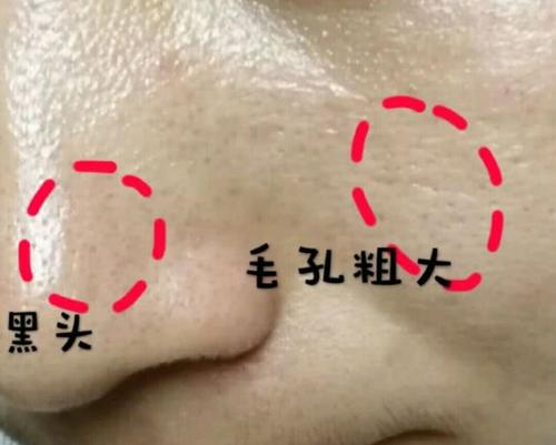 鼻子上都是黑头还有点肿,鼻子上很多颗粒黑头