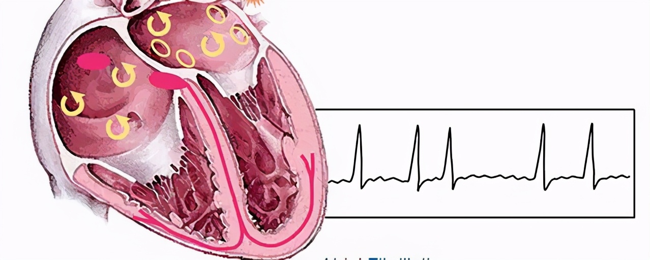 两张量表带您了解房颤的抗凝治疗