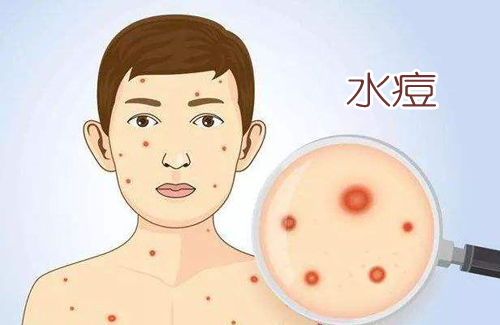 水痘疱疹丘疹一起出现,季节交替带状疱疹进入高发期