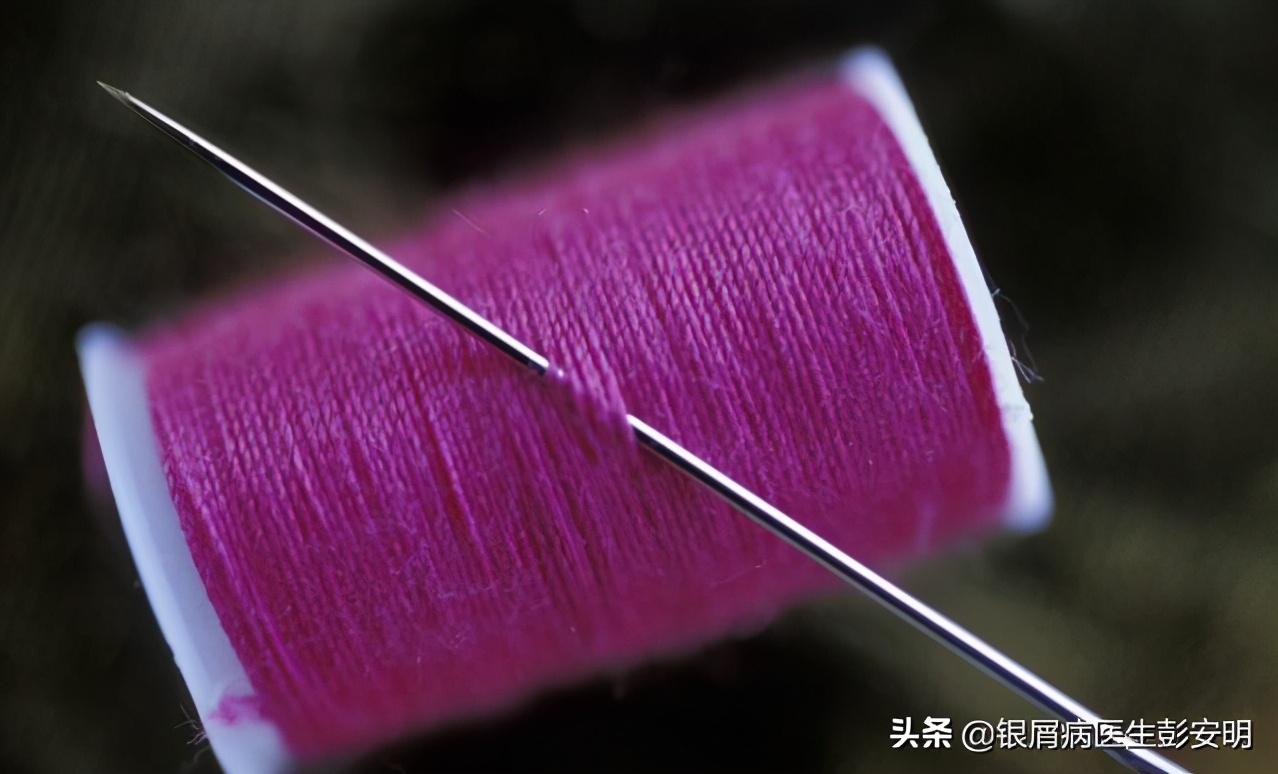 一根缝衣服的针，47岁男子拿来剔牙，剔出满头银屑病