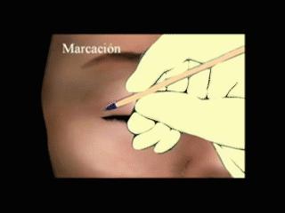 肿眼泡，上睑皮肤略松弛，能割双眼皮矫正吗？