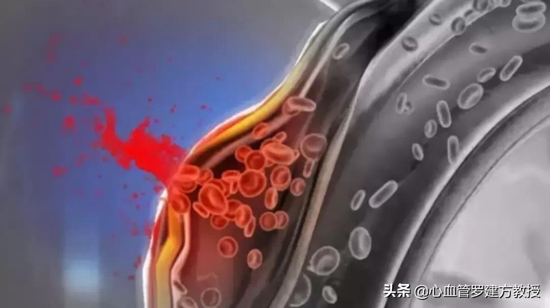 突发胸背痛，不到一天就死亡...警惕这个主动脉疾病