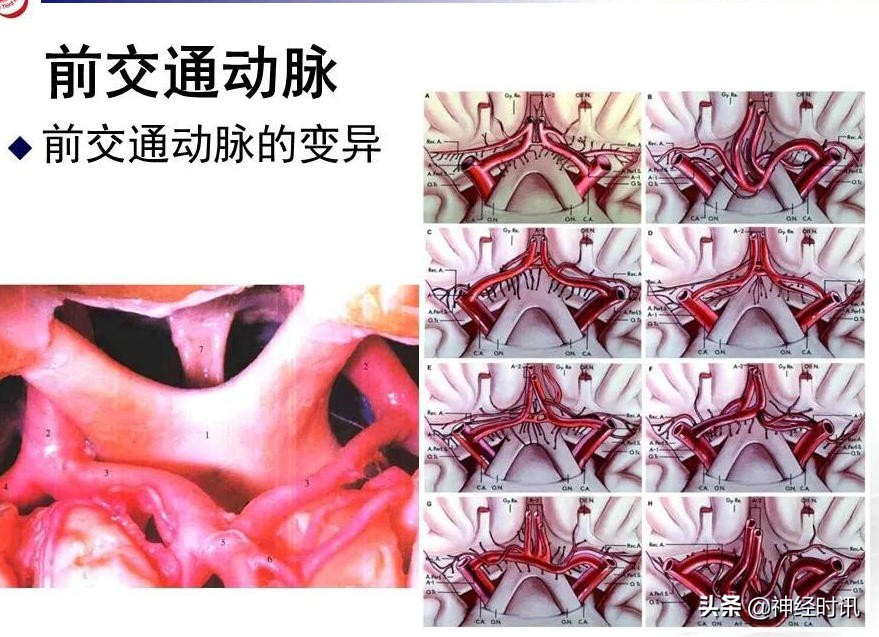 脑动脉解剖学讲解,脑膜中动脉解剖讲解