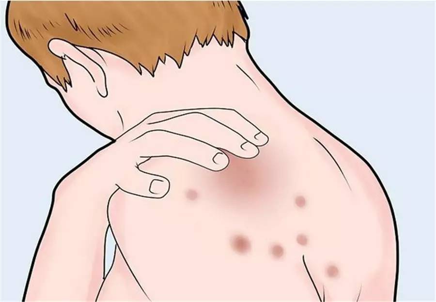 白疕的病因,白疕是什么临床特点