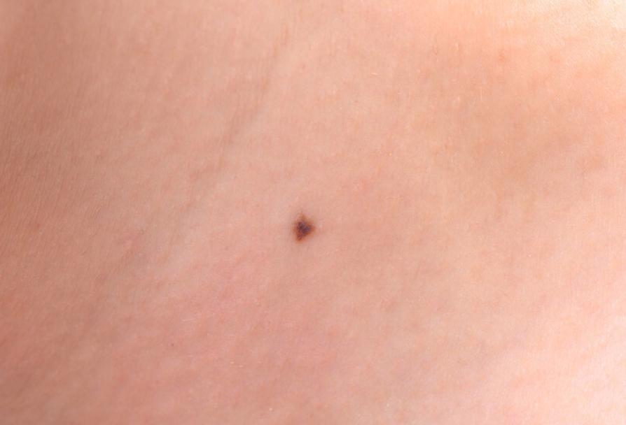 你身上有色素痣吗,你身上的痣有什么含义图片