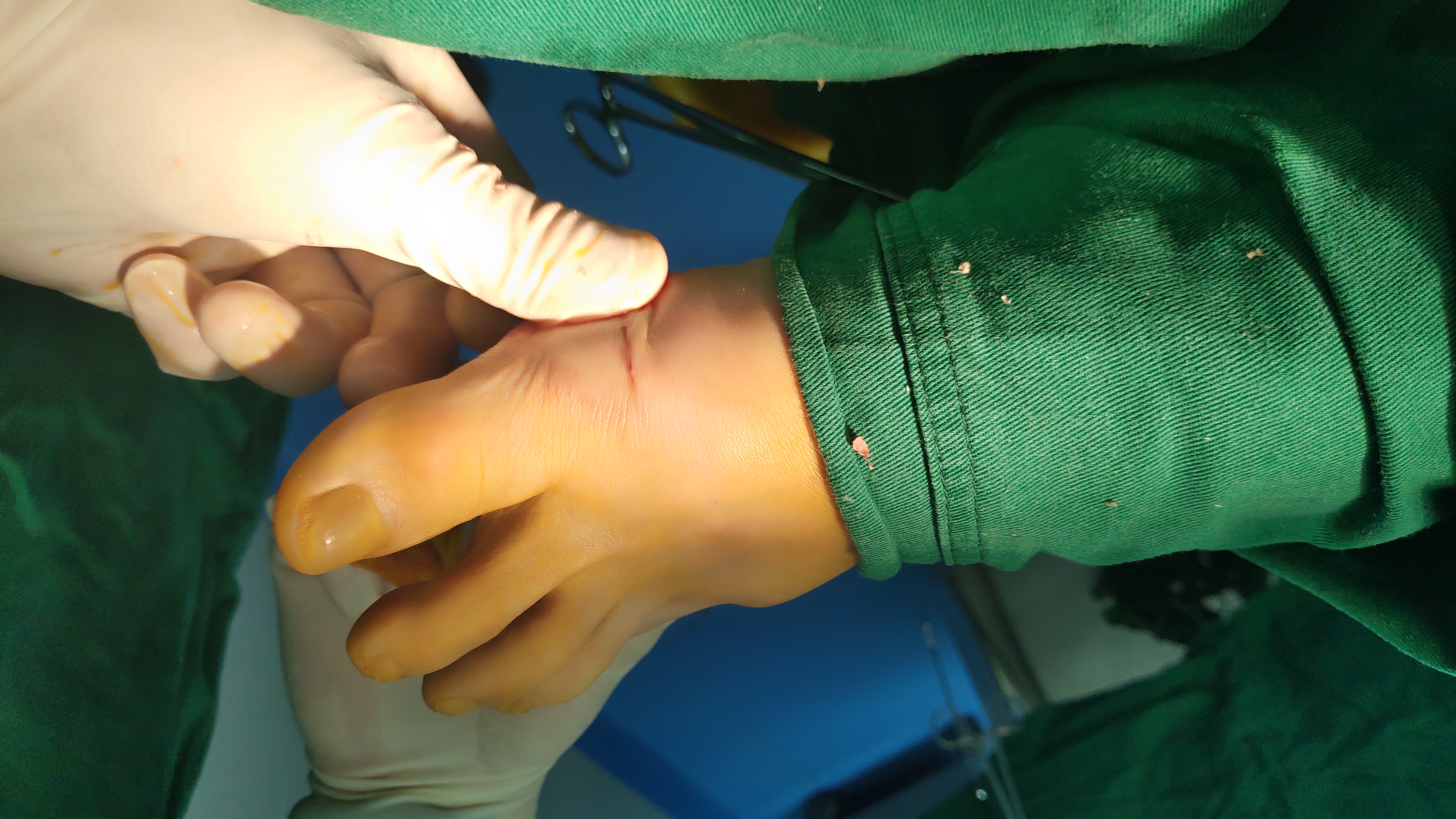 有大脚骨怎么办,让人尴尬的大脚骨该怎么解决