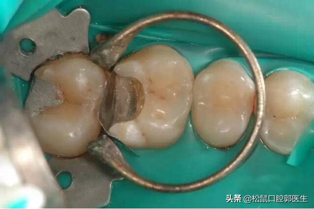 补牙齿补上的会掉吗,补的牙齿老是掉