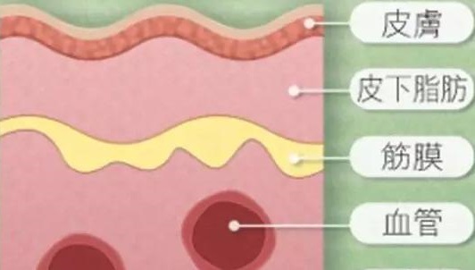 肛周坏死性筋膜炎挂哪科,肛周坏死性筋膜炎怎么得的