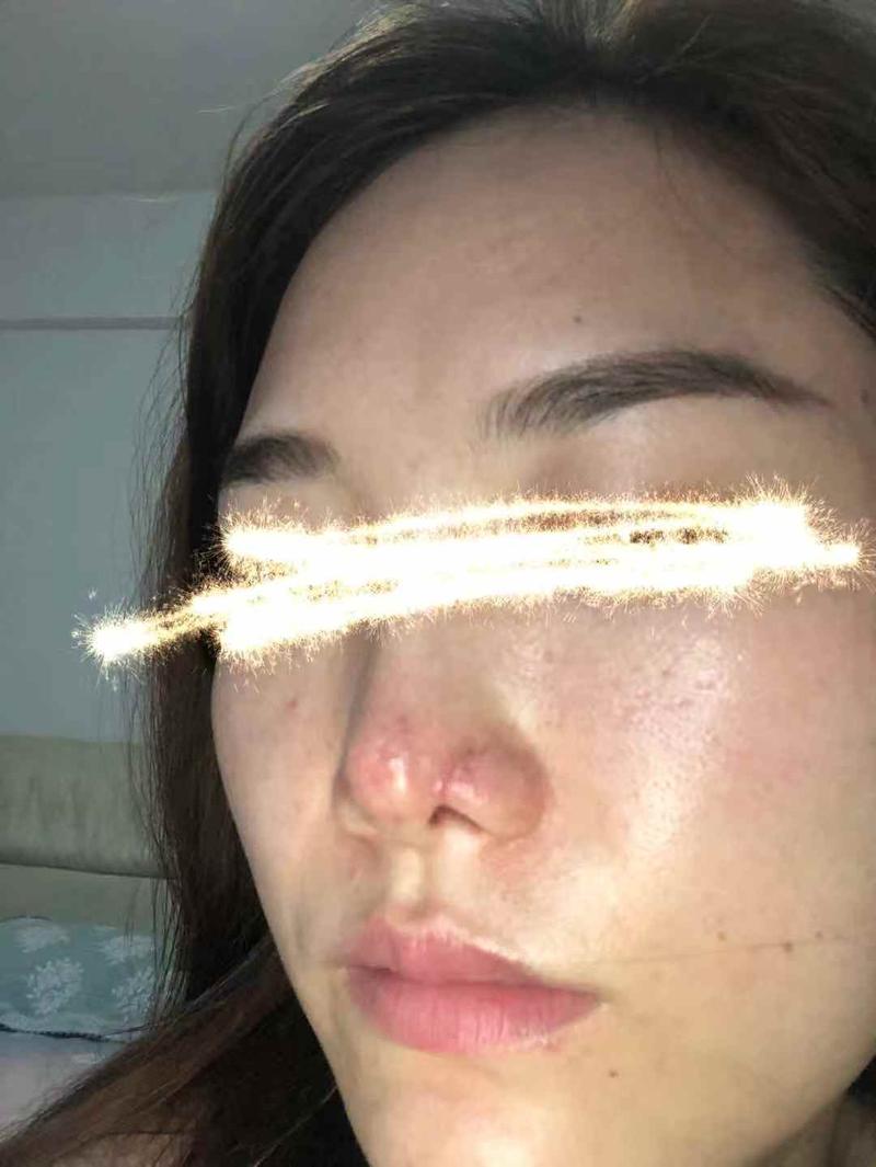 玻尿酸隆鼻皮肤感染,玻尿酸隆鼻一年后红肿