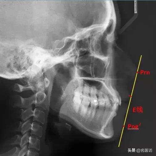 矫正科普|美人在骨不在皮，从神秘的牙片看牙齿和侧貌颜值