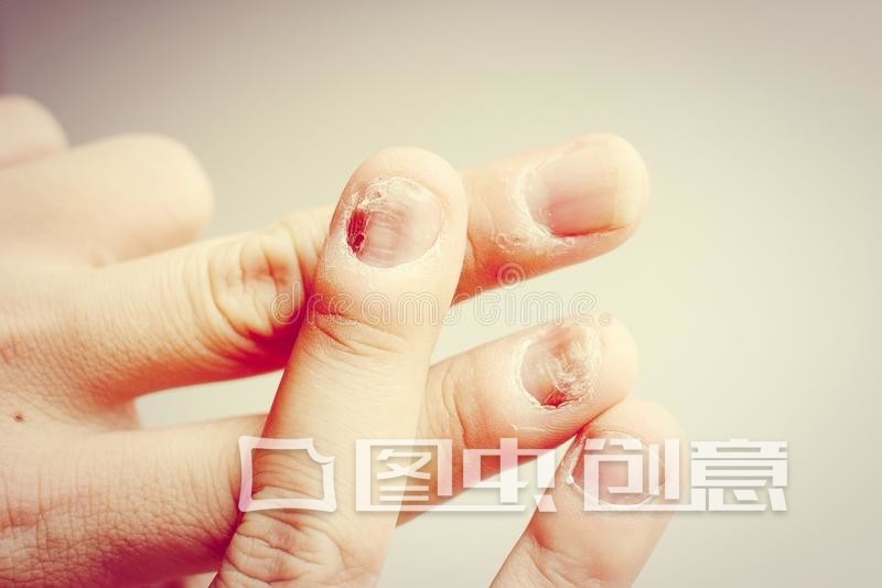 孩子抠指甲心理,孩子抠指甲严重的危害
