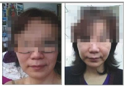 女子打瘦脸针成面瘫向院方索赔,女子瘦脸针打完毁容