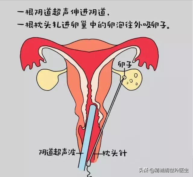 取卵移植痛不痛？取卵后腹水怎么办？