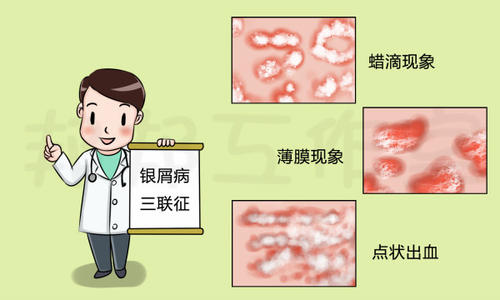 银屑病被误诊为神经性皮炎,刚发现银屑病能治好吗