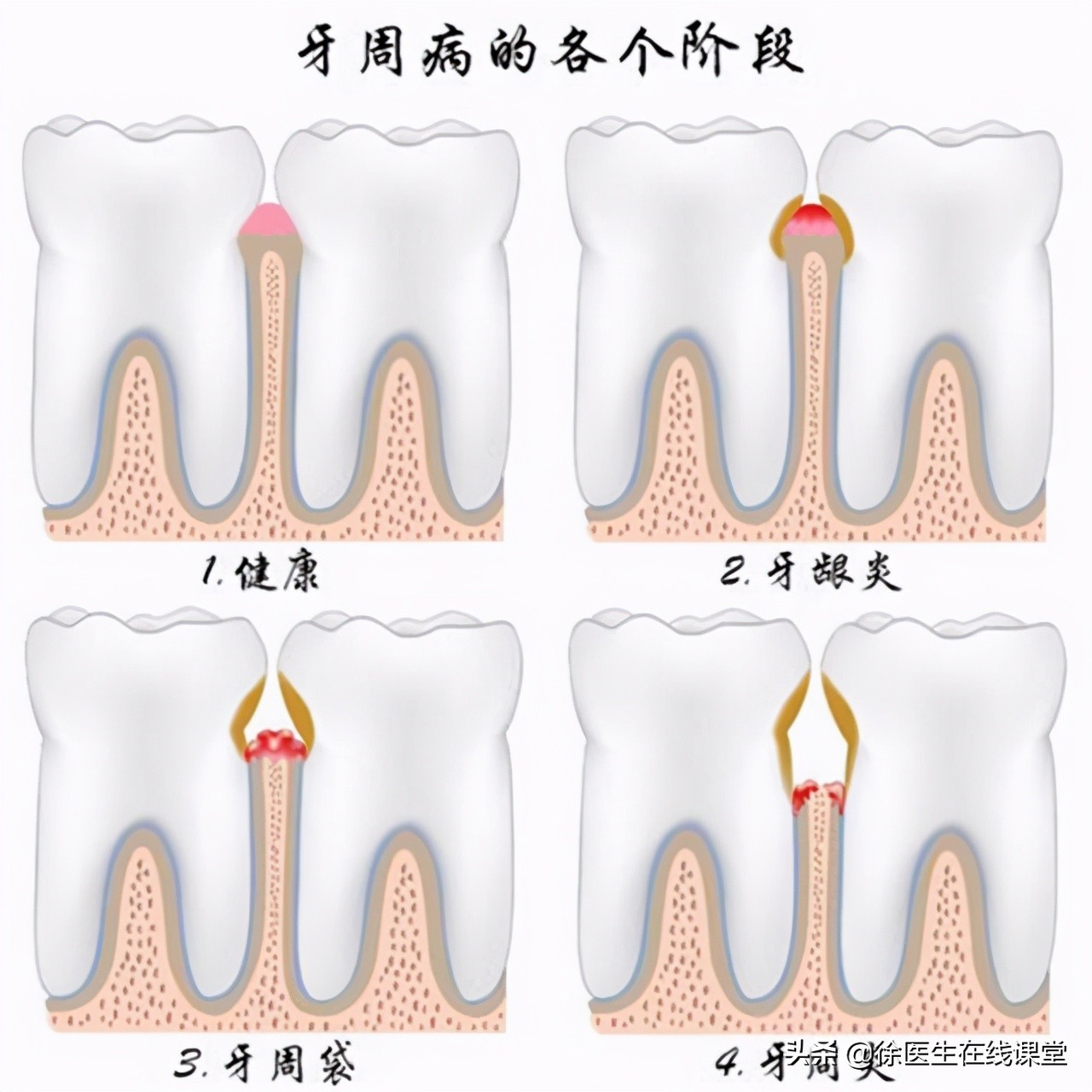 甲硝唑是便宜的和贵的有什么区别,甲硝唑便宜的和贵的有什么区别