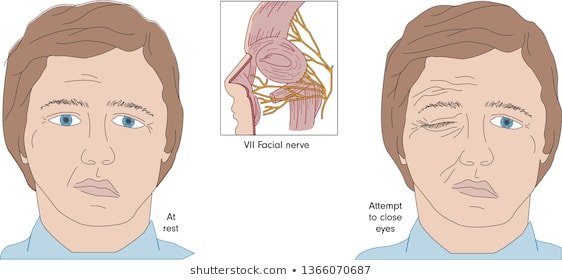 面瘫嘴歪了属于什么病,嘴巴歪是面瘫还是中风