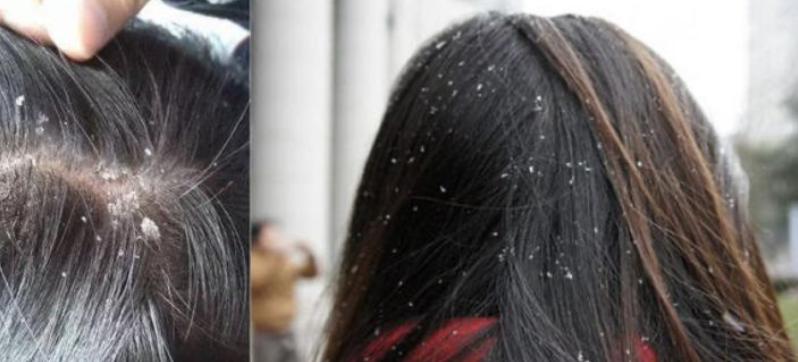 头屑多掉头发严重什么原因,头屑多掉头发是什么原因