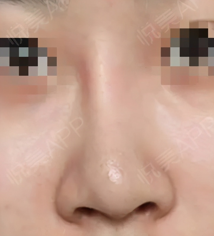 假体有保质期吗最多能用几年,水滴形假体保质期多久