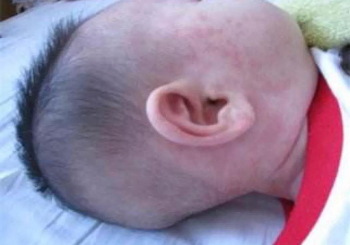 幼儿急疹的症状及相应的处理方法,幼儿急疹的症状及注意事项