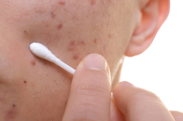 脸上有痘印怎么消除,脸上有痘印有什么办法可以消除