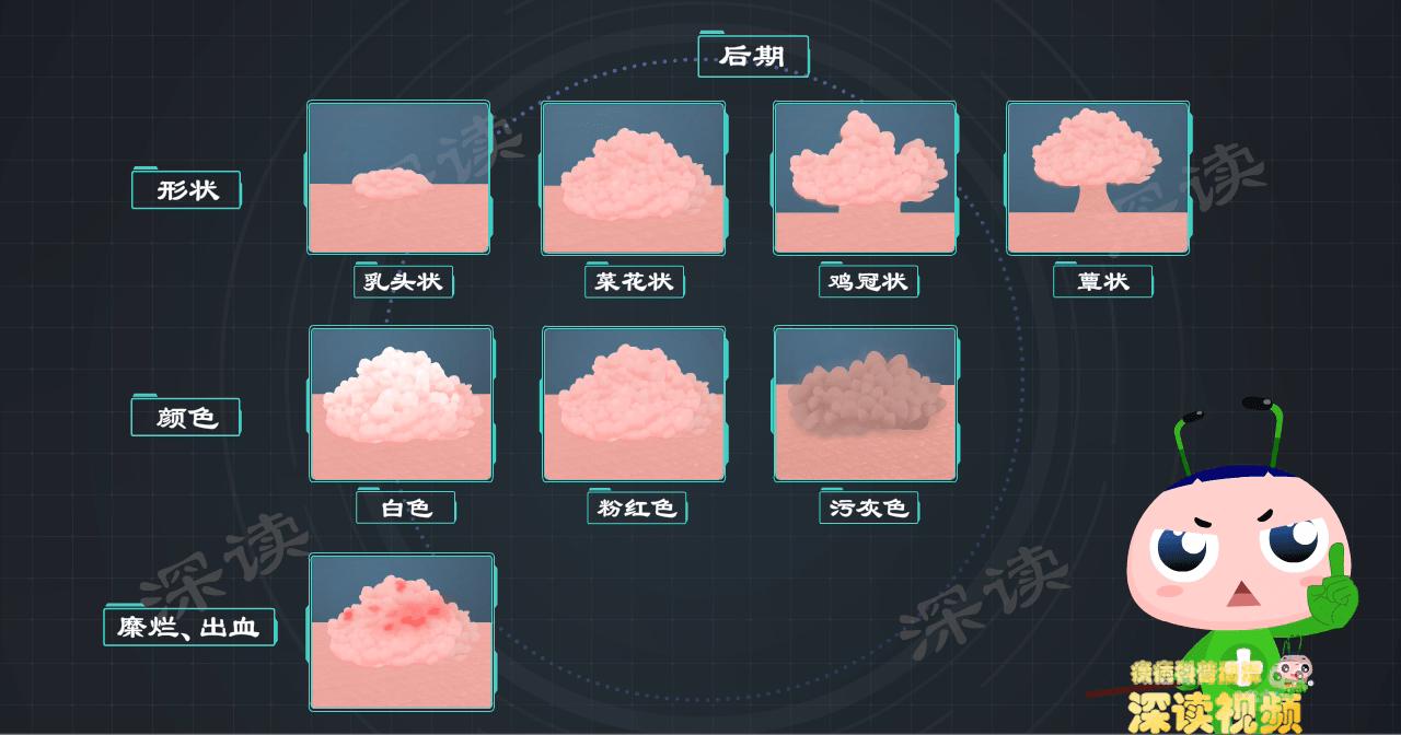 得了hpv一定会长尖锐湿疣吗,小伙口腔长尖锐病毒湿疣