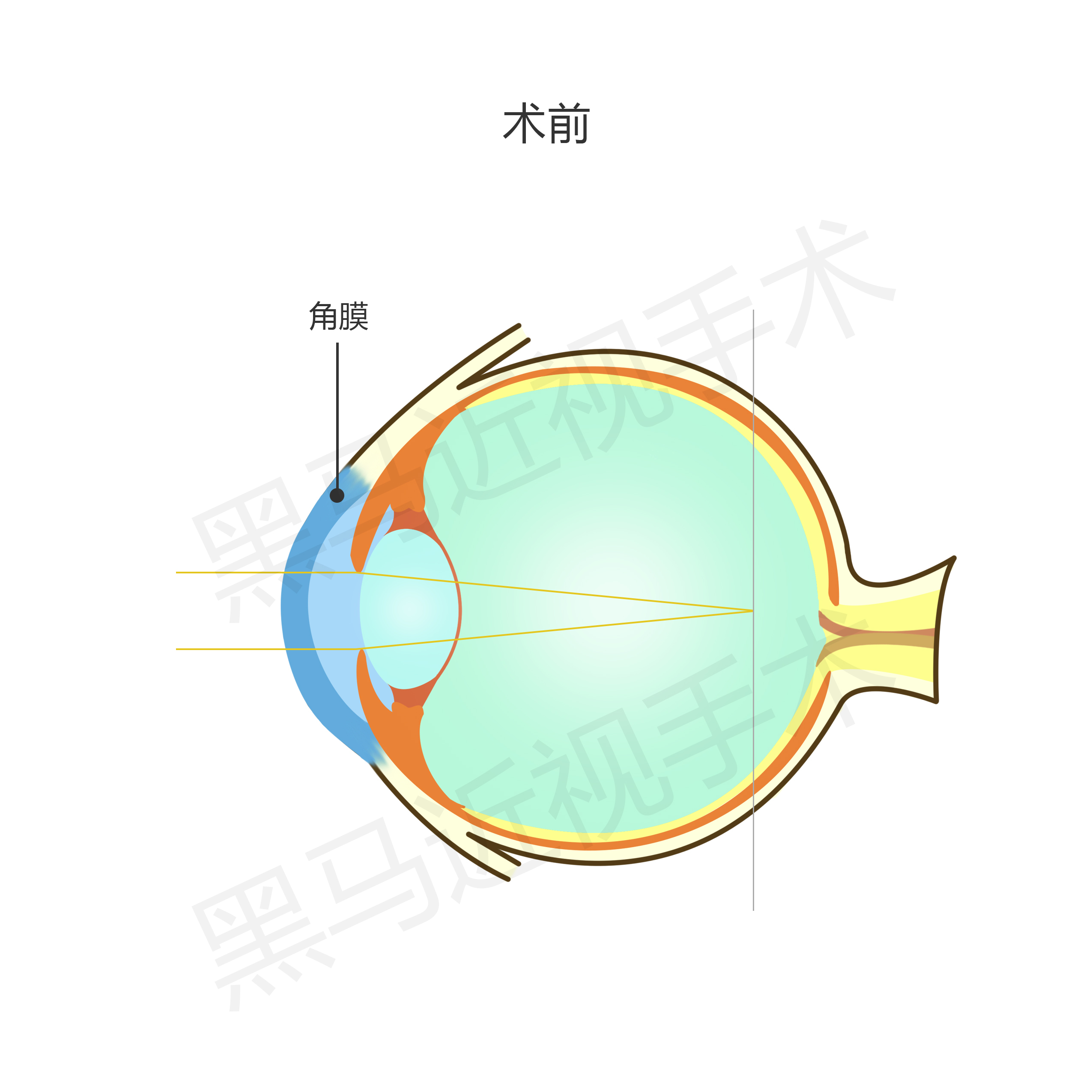 近视300度做激光手术会有后遗症吗,激光近视手术的后遗症有哪些知乎