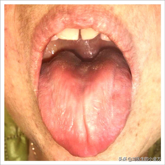 中医舌诊图解100例,中医舌诊图与舌诊口诀