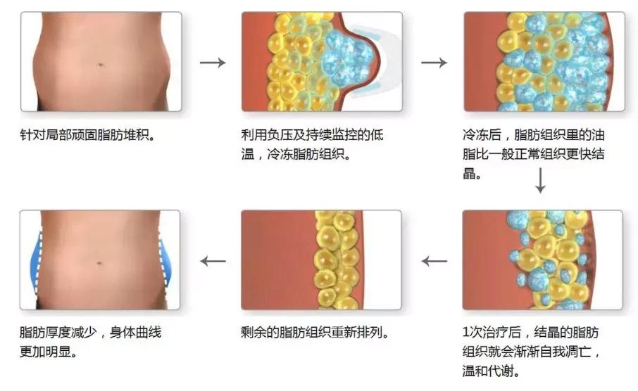 抽脂塑形央视新闻,央视提到减重代谢手术