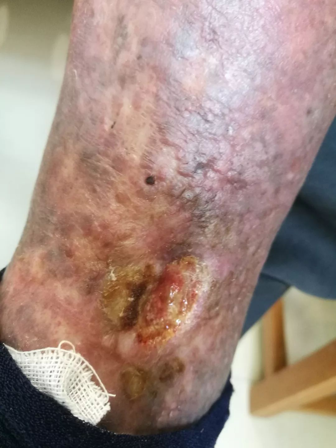 色素性紫癜性皮肤病是啥,色素性紫癜性皮肤病是什么