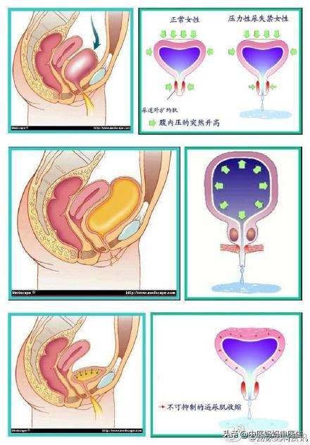 40岁产后女性漏尿怎么改善,女人生完孩子总是漏尿松弛怎么办
