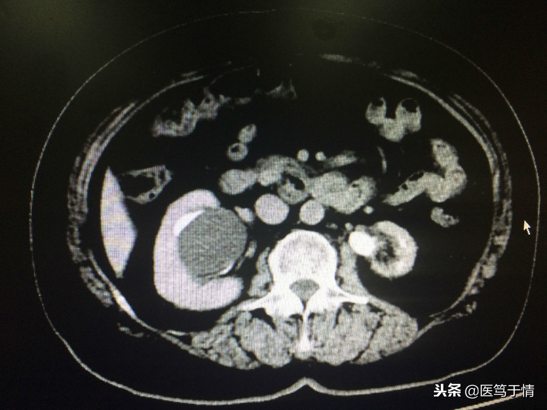 肾囊肿10*9mm需要做手术么,肾囊肿14mm用做手术吗
