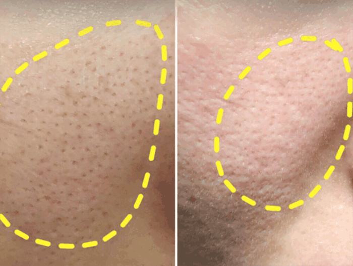 毛孔粗大怎么办教你一招,毛孔粗大怎么办护肤步骤