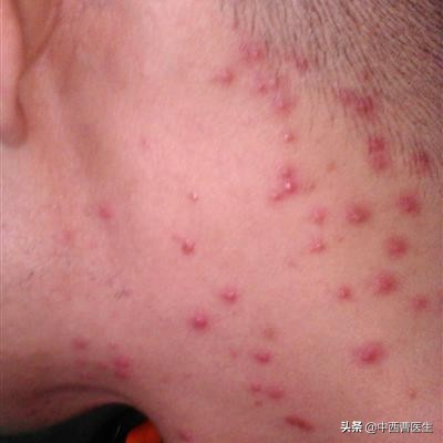 梅毒属于性传播疾病吗,梅毒是怎么传染的会有什么危害