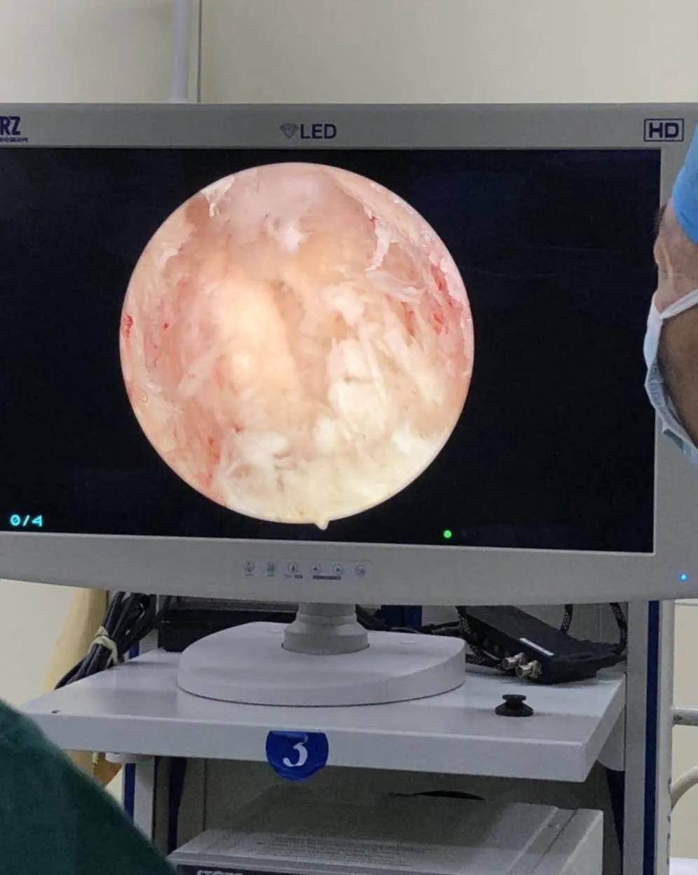 南通首例！海安市中医院骨伤科成功开展UBE技术治疗腰腿痛