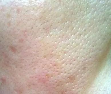 脸部肌肤松弛胶原蛋白流失怎么办,脸上毛孔粗大怎么修复最有效