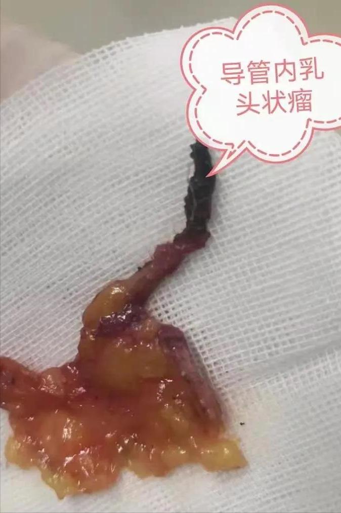 乳腺导管内乳头状瘤，该如何诊治？