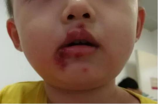 宝宝嘴巴长溃疡是手足口病么,手足口病胳膊腿关节起疱疹吗