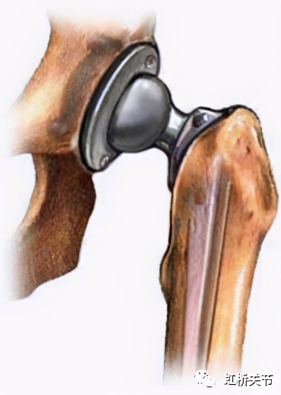 人工关节置换术后感染,人工关节置换术后感染要清创几次