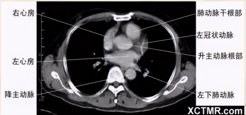 女性盆腔ct断层解剖结构图,女性盆腔脏器ct解剖