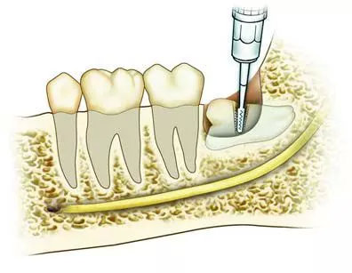 智齿长歪了顶着腮好拔吗,如果智齿长歪碰到其他牙齿会疼吗