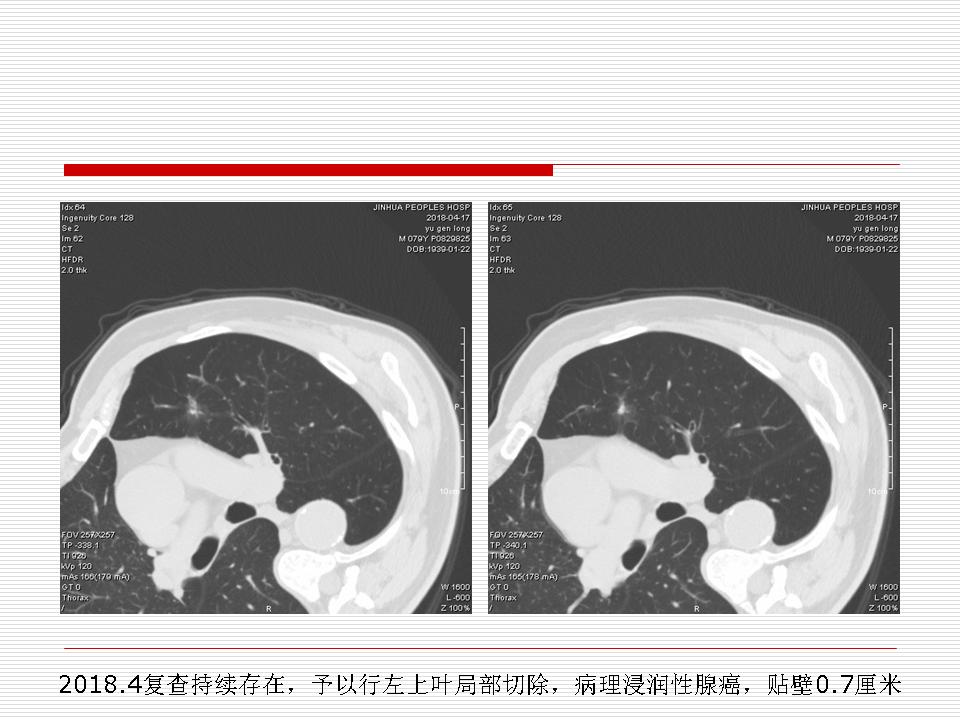像炎症的肺癌能治好吗,医生说可能是肺癌也可能是炎症