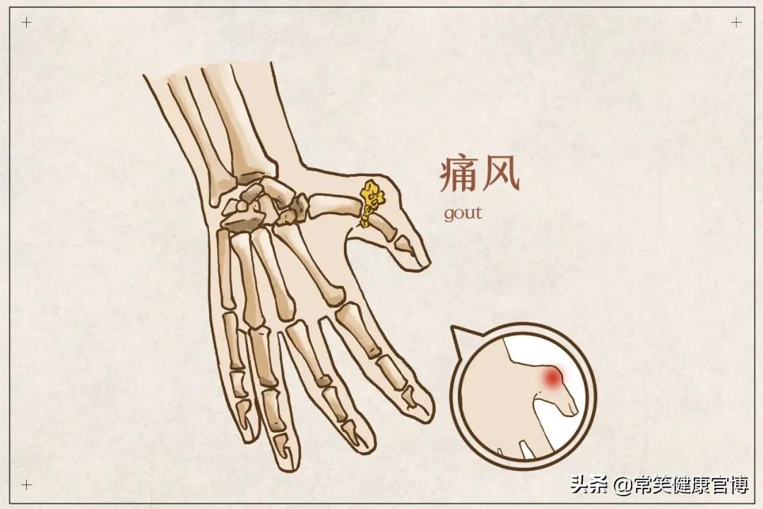 哪些人容易患痛风性关节炎,浅谈痛风性关节炎误区