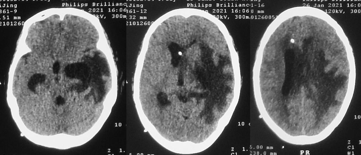 脑脓肿合并脑膜炎需要手术吗,脑脓肿进入左侧脑室严重吗