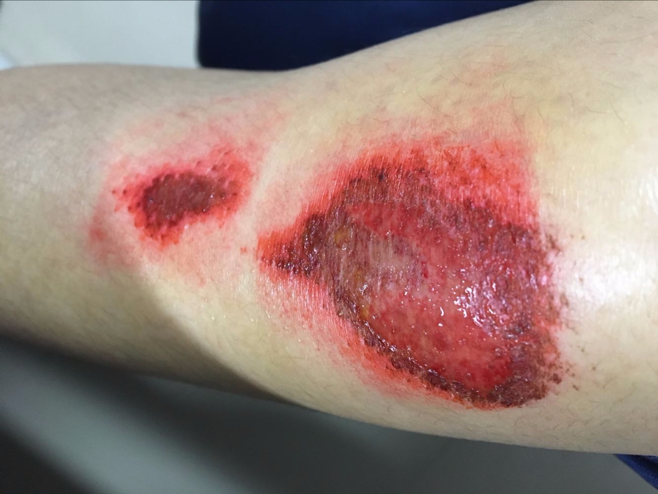 三岁女童手指被压断后续,小孩手指被夹伤需要多久才能恢复