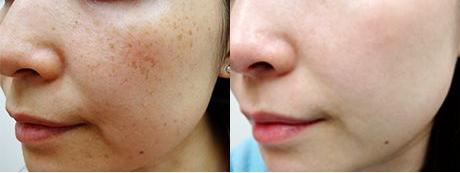 国际上有根除遗传雀斑的方法吗,专业祛斑四天根除遗传性雀斑