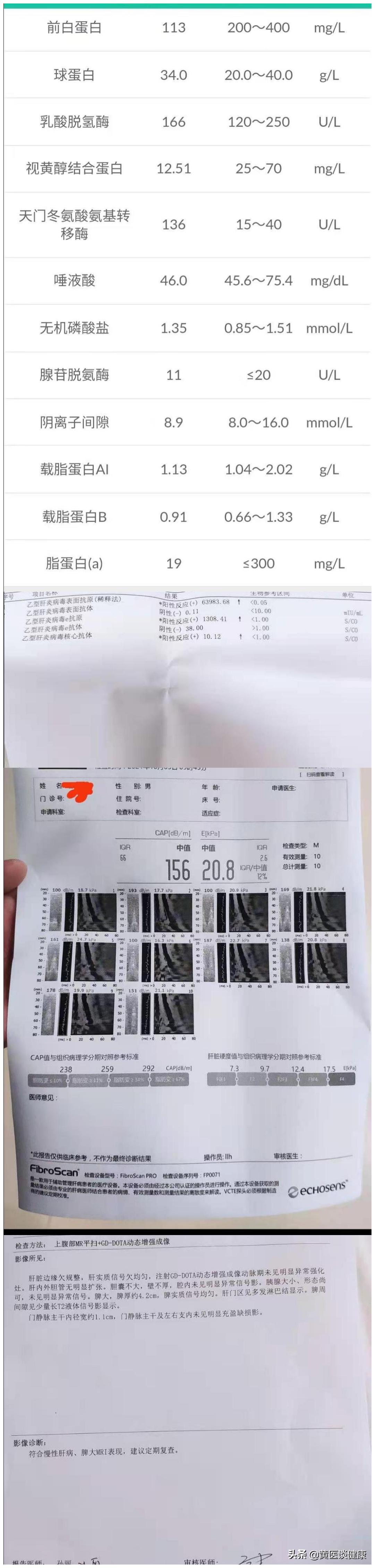 替诺福韦耐药肝功能正常,替诺福韦抗病毒后胆红素高怎么办