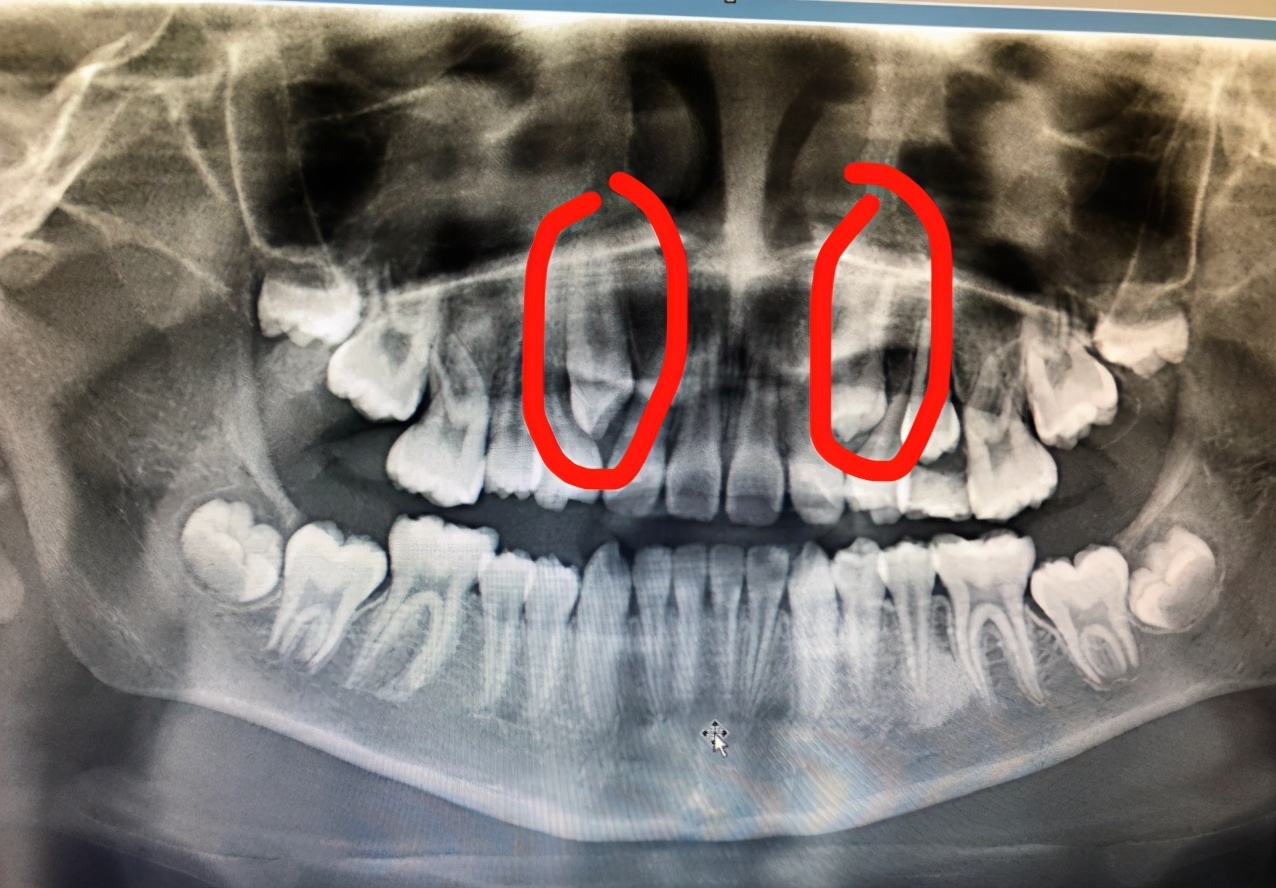 小孩长了虎齿怎么办,小孩长老虎的牙可以矫正吗